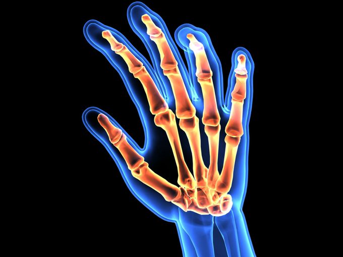 RA Rheumatoid Arthritis, a hand 3d xray