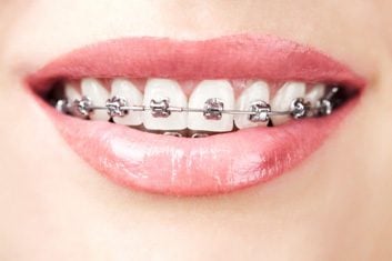 Straighten your teeth with these braces options for adults