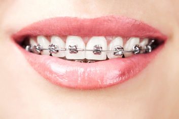 braces for adults
