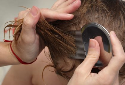 Natural home remedies: Head lice