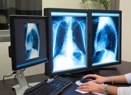 The five deadliest cancers for women: Lung cancer
