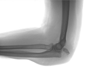 elbow fracture x-ray