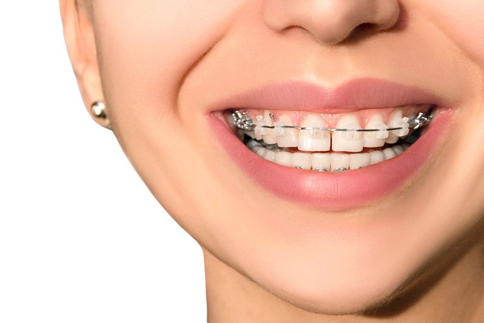 adult-orthodontics-braces