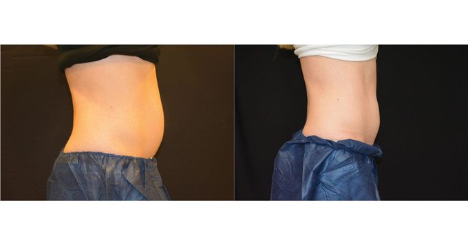 Coolsculpting_before_and_after