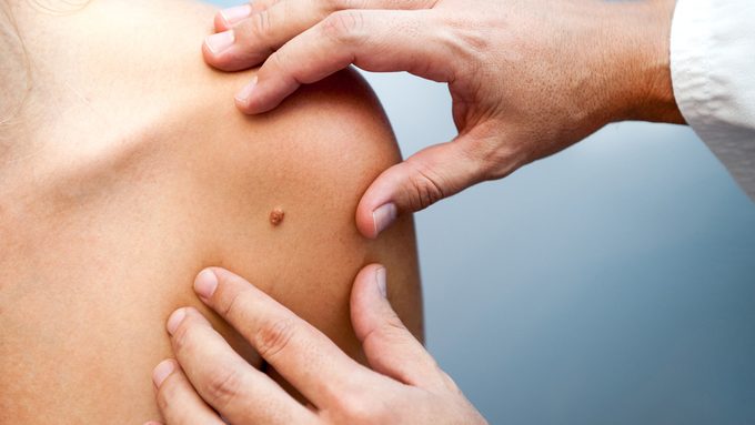 new skin cancer treatments: woman getting her mole checked