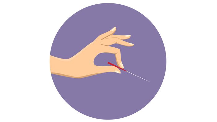acupuncture for sports injuries