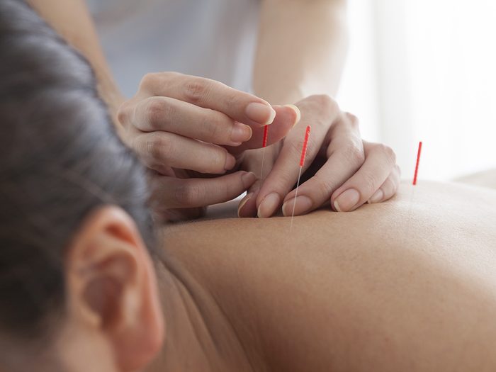Menopause symptoms, woman receives acupuncture on her back