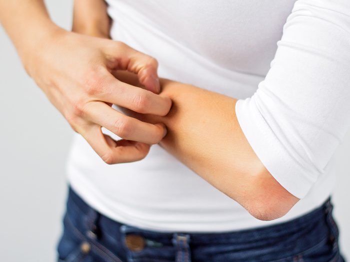 Eczema, woman scratching her arm