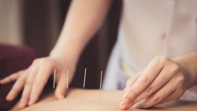 Acupuncture, needles in woman's back