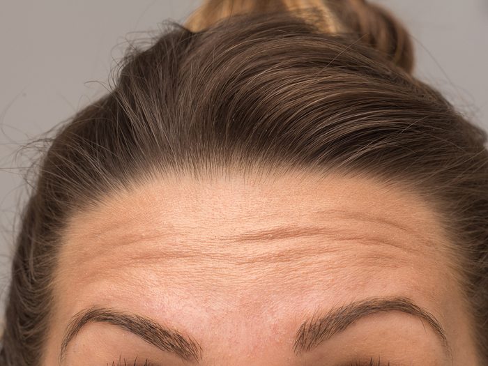 facial wrinkles forehead