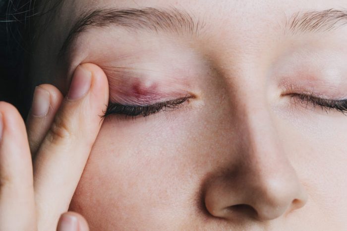 How to get rid of a stye
