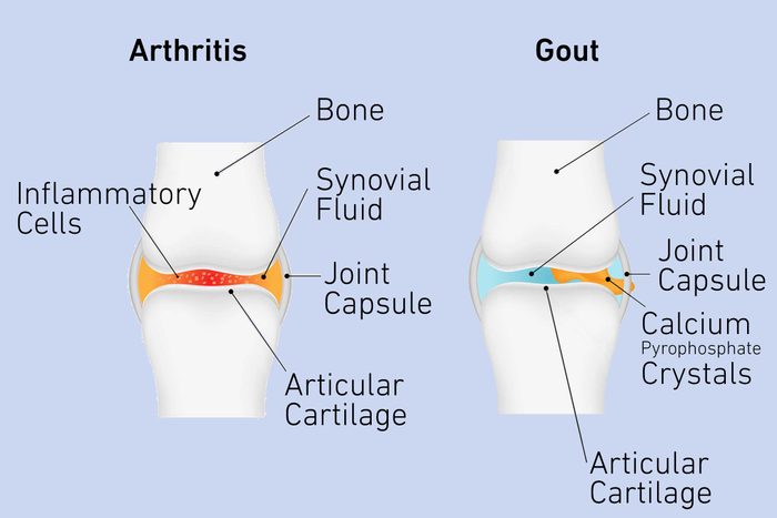 arthritis gout
