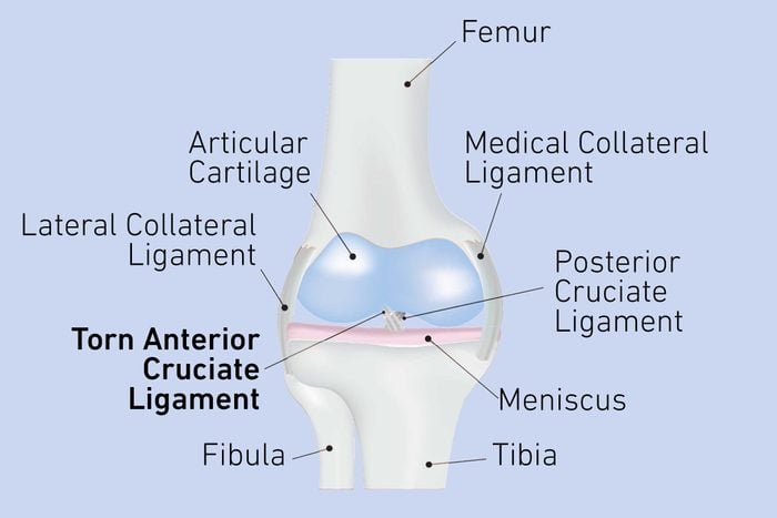 torn ACL