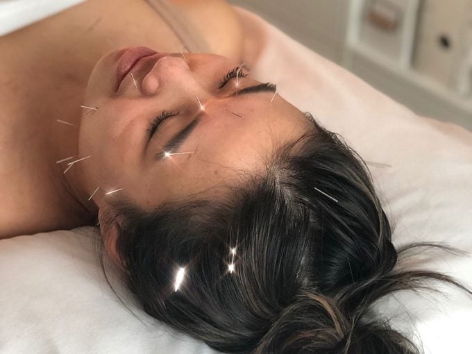 Madelyn Chung facial acupuncture