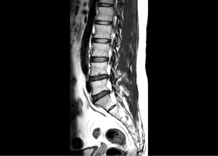 Herniated disc at spine make me very painful, medical picture case studies.