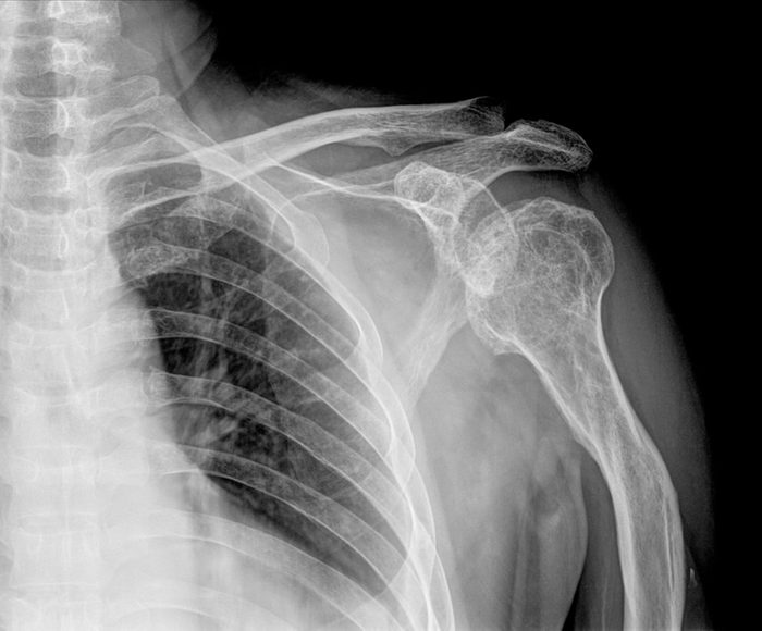 regular shoulder on x-ray