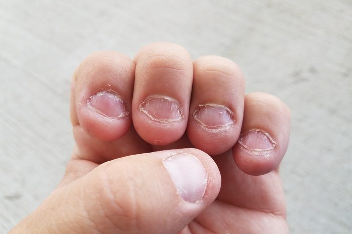 disgusting bitten fingernails on man's hand