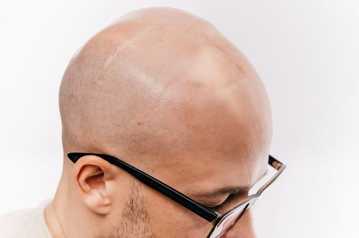 Closeup of bald male head after oncology operation. Brain tumor irradiation and chemotherapy marks. Survivor patient after cancer. Hairless man with scars. Skin irritation. Neurosurgery operation