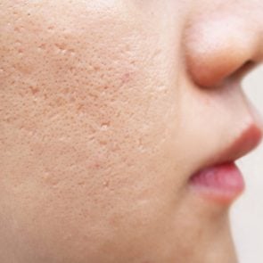 icepick scars acne on cheek on face women cause of happen because of skin loses collagen, so the overlaying skin collapses and leaves a hole, narrow and deep using for cream or skin care product conce