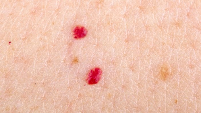 Cherry Angiomas How To Get Rid Of Those Bright Red ‘moles Best Health