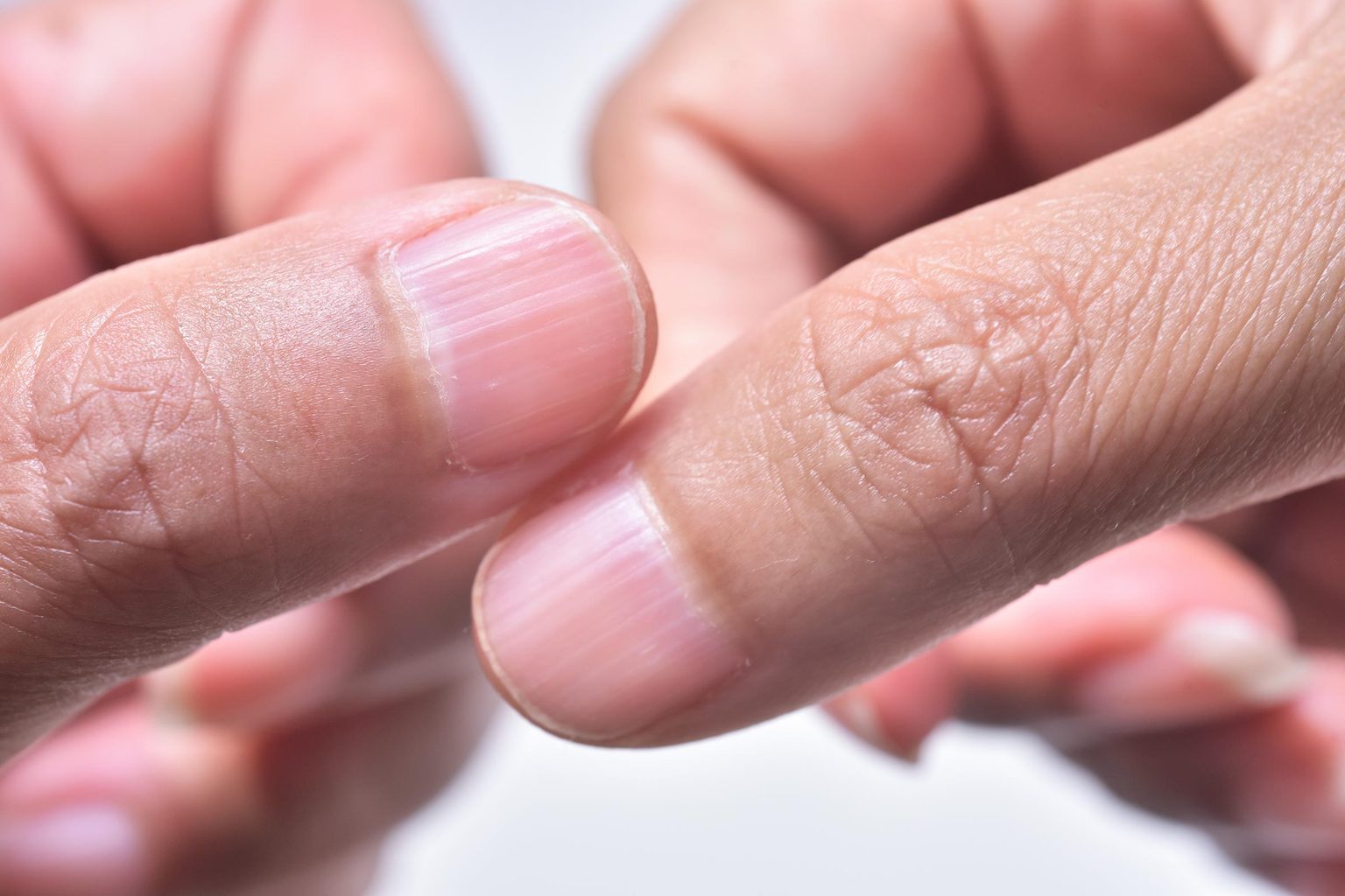 What It Means If You Have Ridges on Your Nails | Best Health Canada