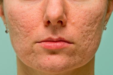 02-boxcar-The-5-Types-of-Acne-Scars-and-How-to-Treat-Them-170660708-Budimir-Jevtic