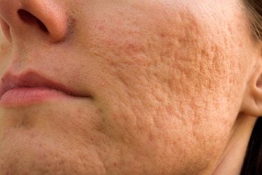 03-rolling-The-5-Types-of-Acne-Scars-and-How-to-Treat-Them-153263516-Budimir-Jevtic
