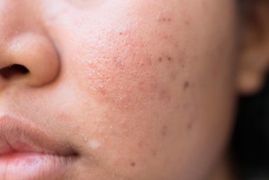 05-hyperpigmentation-The-5-Types-of-Acne-Scars-and-How-to-Treat-Them-435055855-frank60