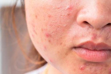 06-combination-The-5-Types-of-Acne-Scars-and-How-to-Treat-Them-460133194-frank60