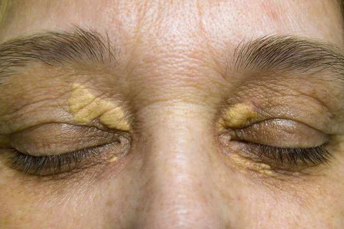 Xanthelasma on the skin of the eyelids