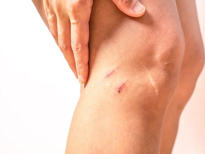 infected cut srape knee 