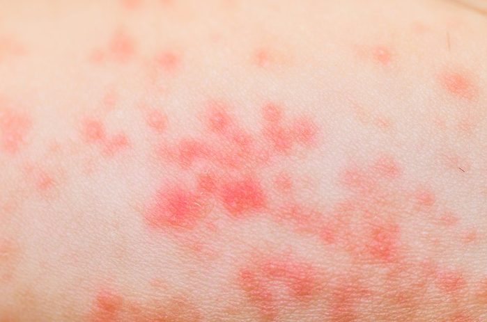 ill allergic rash dermatitis eczema skin texture