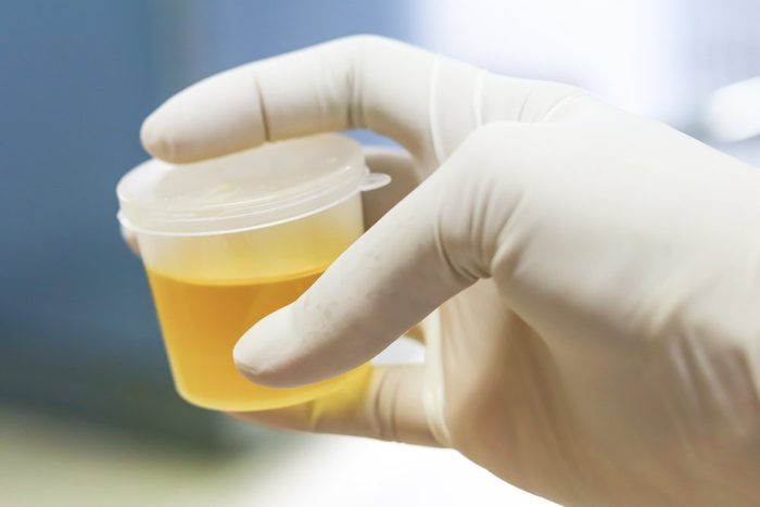Healthcare And Medicine. Medical urine test, close-up