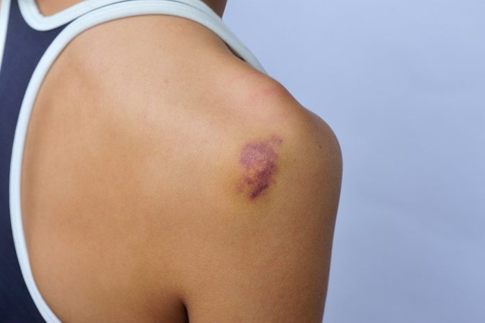 bruise and injury on female shoulder 