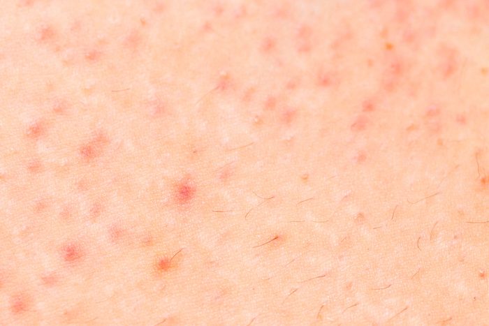 close-up of skin with folliculitis