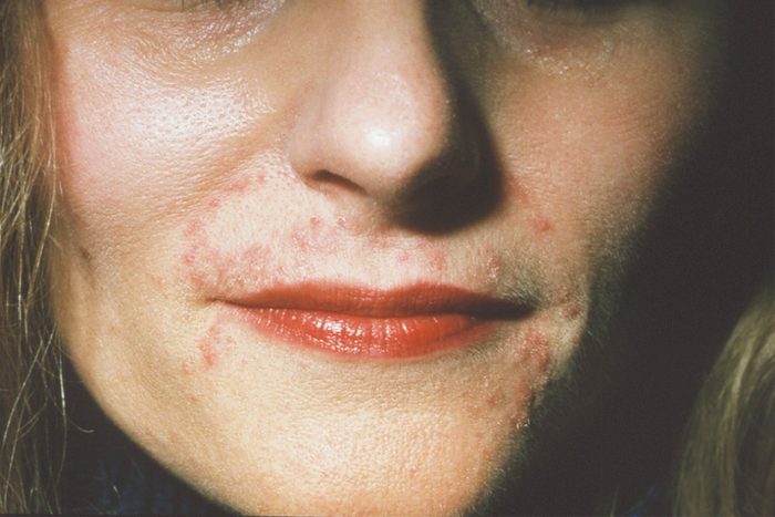woman with rash around her mouth (perioral dermatitis)