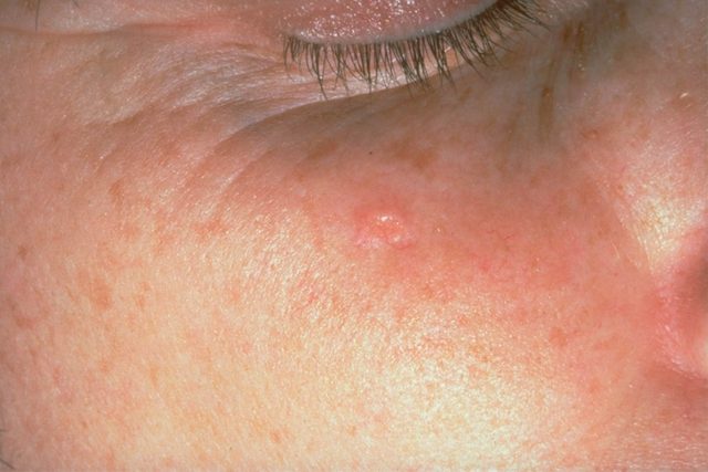 person with redness and bumps on bridge of nose (Sebaceous hyperplasia)