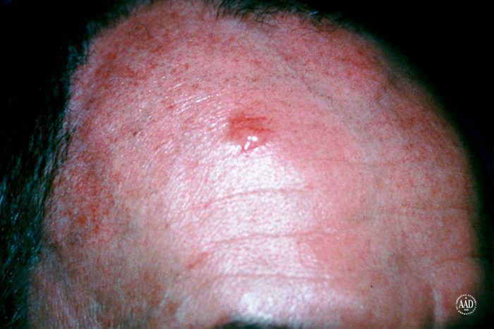 basal cell carcinoma on forehead