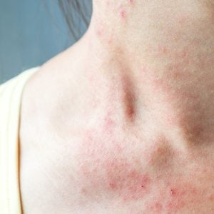 what does eczema look like