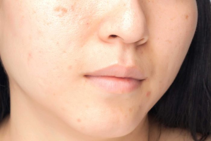 worst skin care advice brown spots