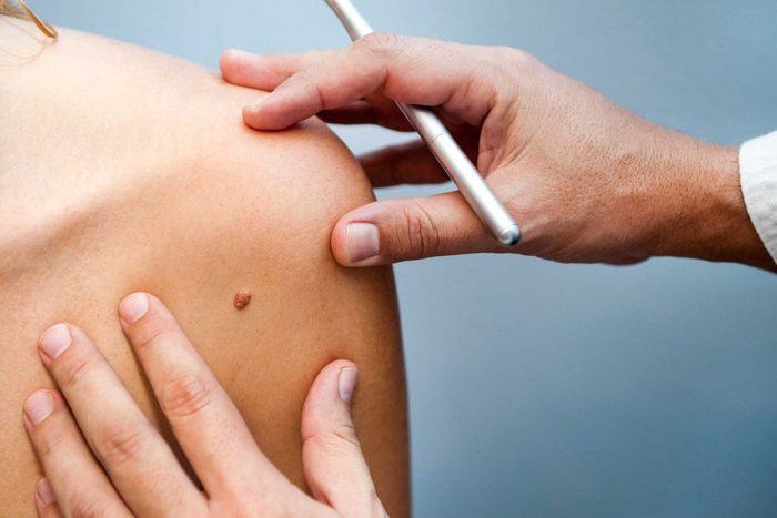 worst skin care advice mole removal