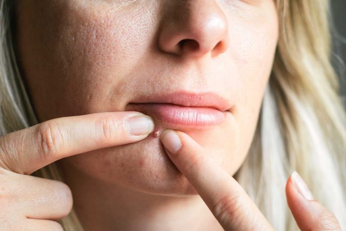 worst skin care advice pimple