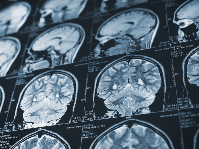 Alzheimer’s Disease - brain scan