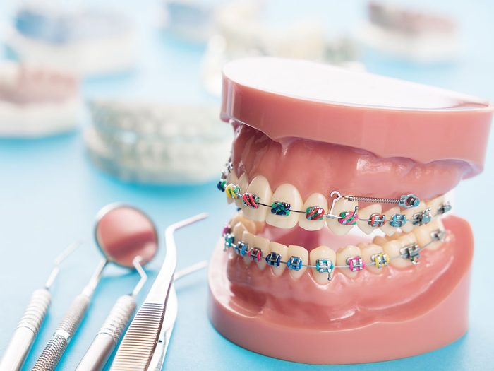 orthodontist secrets braces