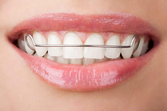 orthodontist secrets retainer