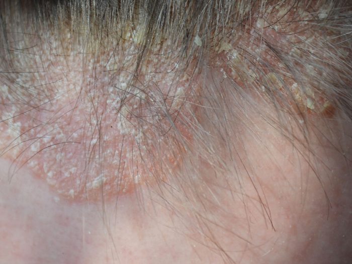 scalp psoriasis - scalp psoriasis