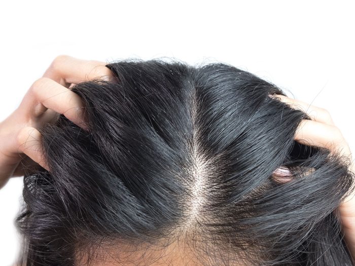 scalp psoriasis - woman itching scalp