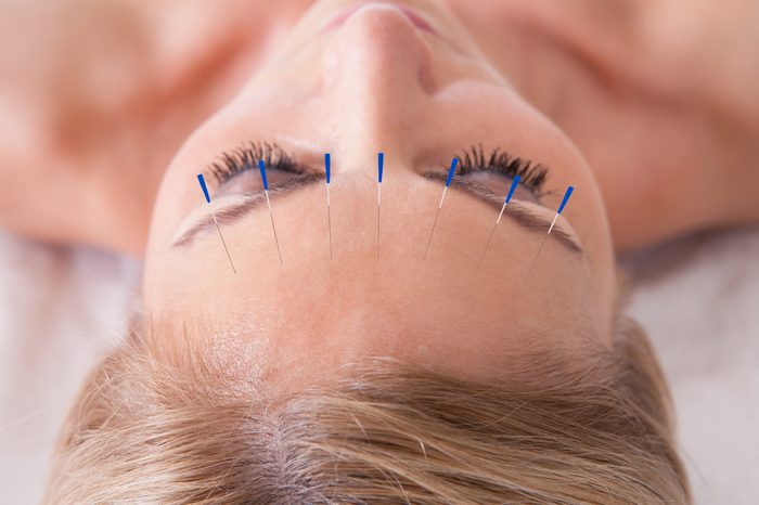 Anti-Aging Treatments | Detail Of A Woman Receiving An Acupuncture Needle Therapy