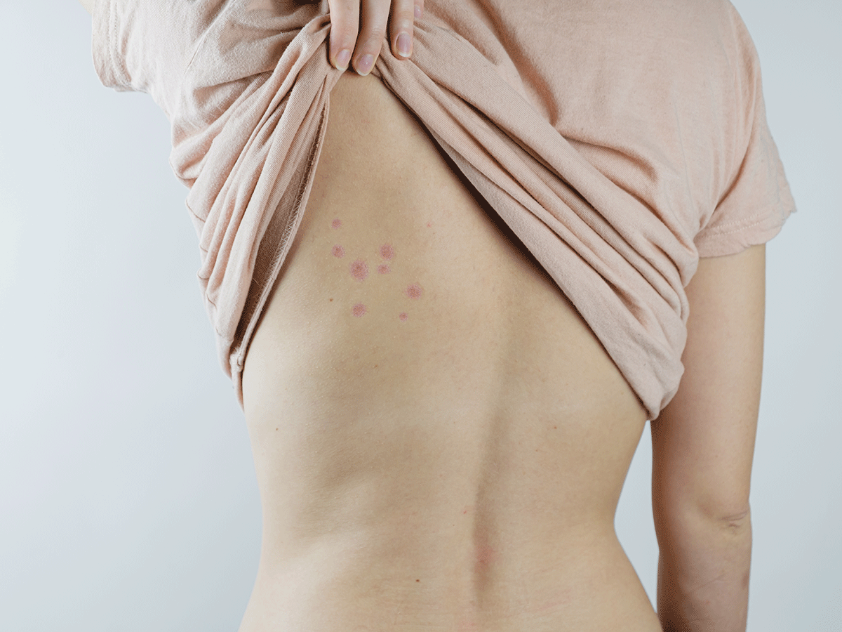 Bug bites: what happens and what to do