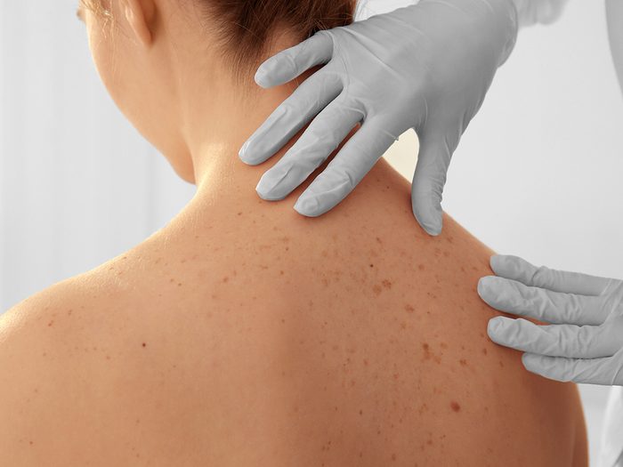 skin cancer risks